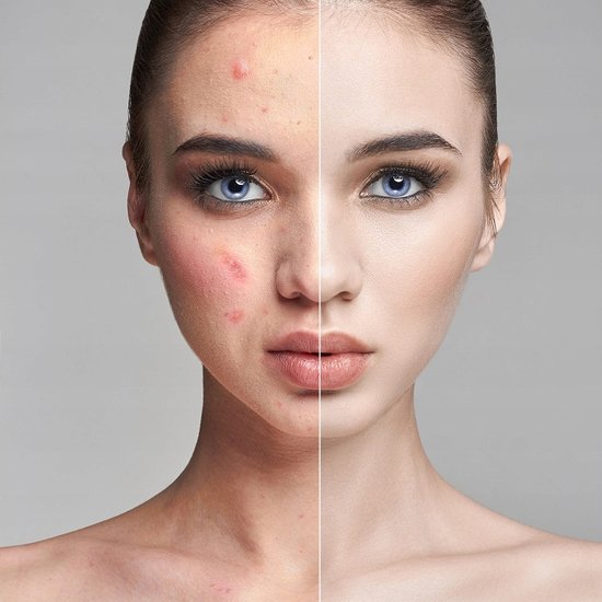 119 : Ultrasonic face cavitation peeling 5in1